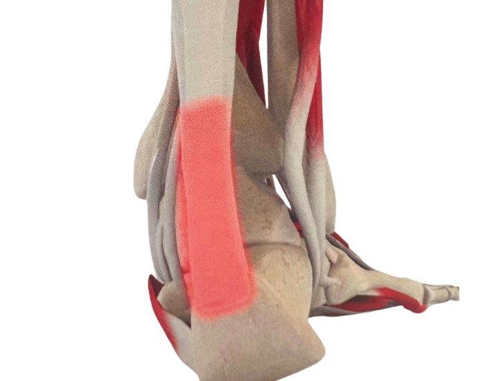 Achilles tendonosis