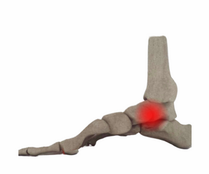 Midtarsal Joint Sprain