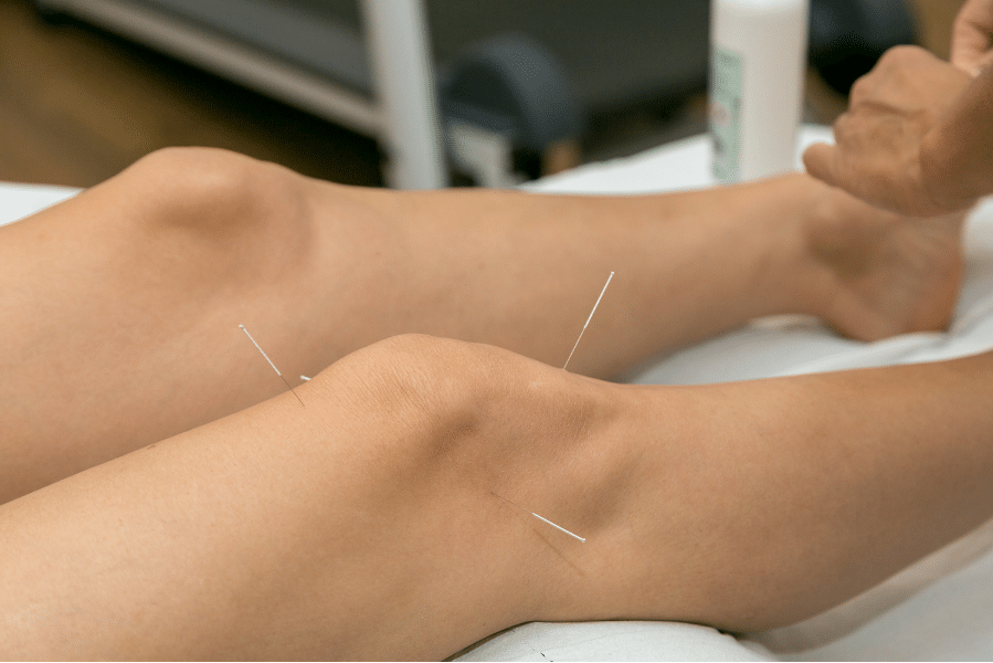 Dry needling